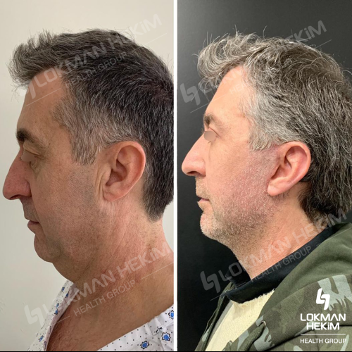 Thread lift Before / After photo